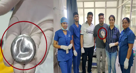 6 माह के मासूम की सांसें अटकीं: 1.5 इंच का ढक्कन गले में फंसा - डॉक्टरों की तत्परता से टला बड़ा हादसा