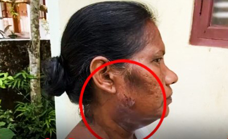 SIR के लिए पहुंची महिला BLO पर मकान मालिक ने पालतू कुत्ता छोड़ा ! अधिकरी बुरी तरह घायल